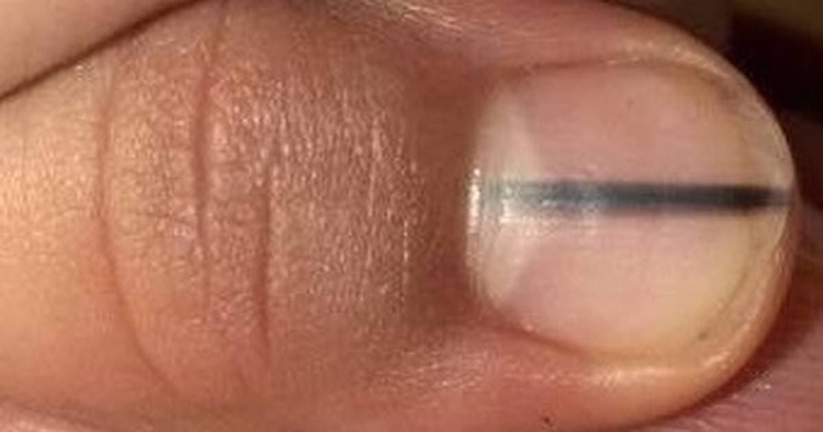 Crna crta na noktu: Znak koji može spasiti život